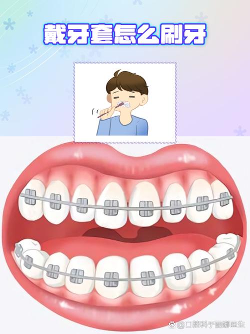 正畸刷牙怎么刷才干净？图解方法详解-图2