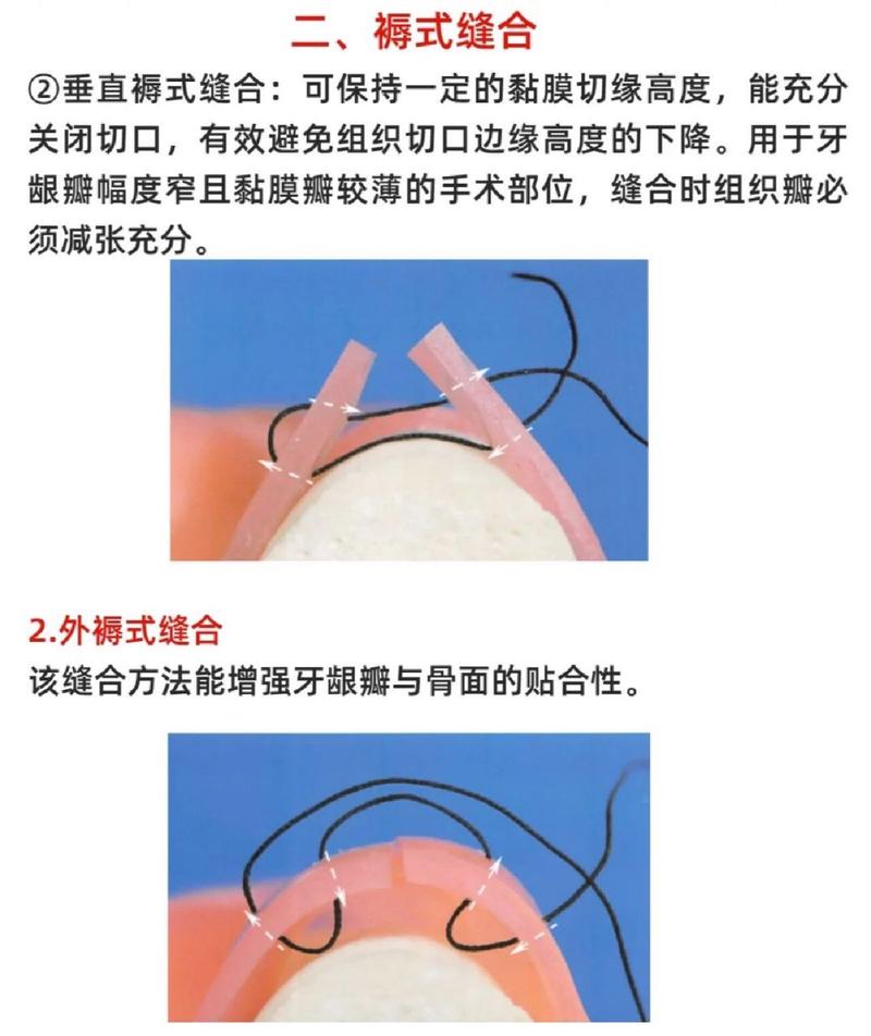 口腔手术缝合方法如何正确选择与操作?-图1 口腔手术缝合方法如何正确选择与操作?-图1