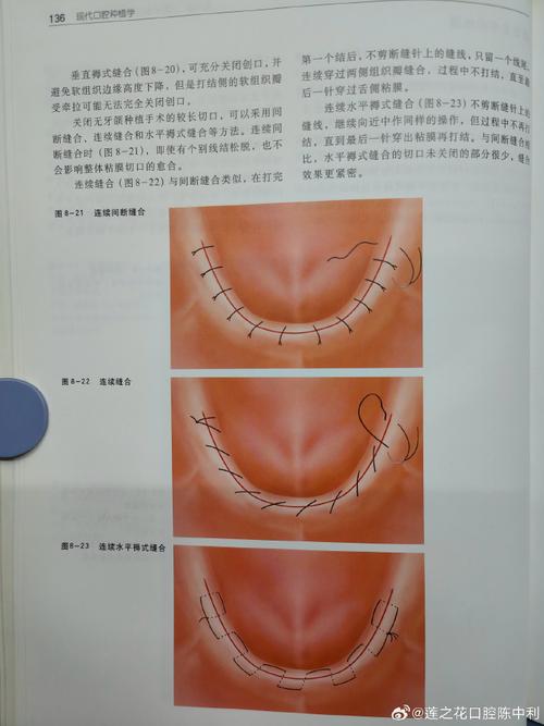 口腔常用缝合方法有哪些？如何选择合适的方法？-图2
