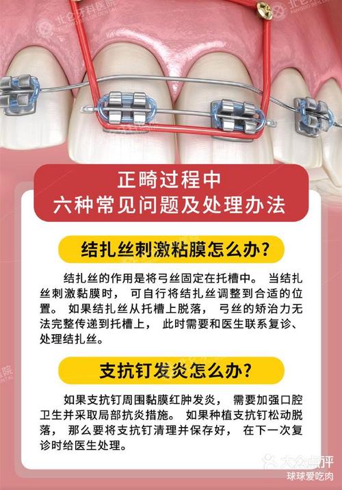 正畸连续结扎方法如何提升结扎效率与效果？-图1