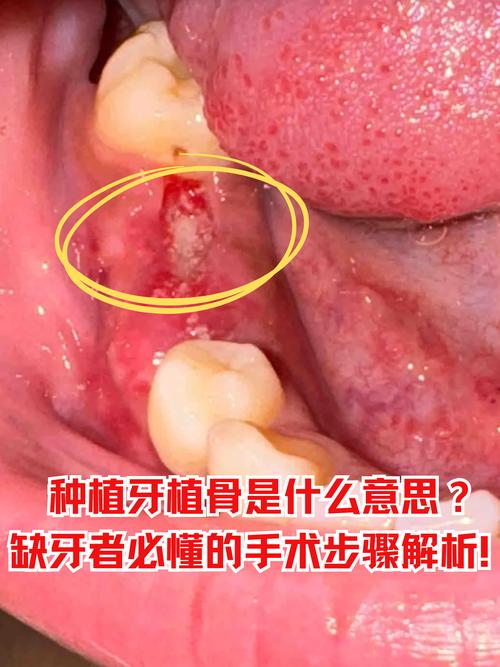 种牙时骨头短会影响种植吗？怎么解决？-图2