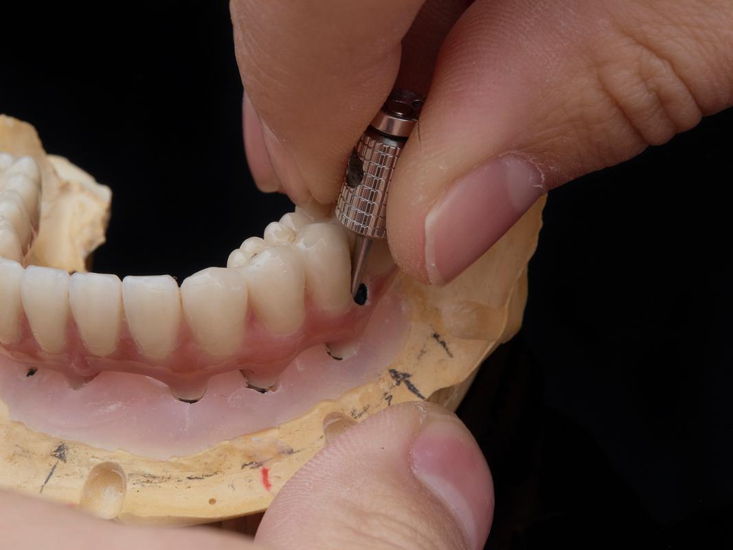 种牙打桩期间，饮食宜忌要注意哪些？-图2