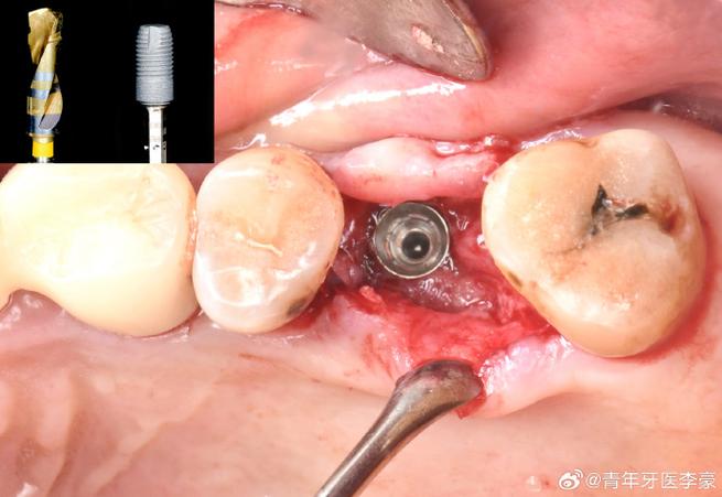 种牙上颌窦提升手术过程到底疼不疼？-图1