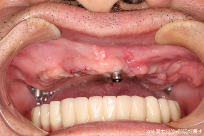 种牙上颌窦提升手术过程到底疼不疼？-图2