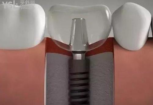 正规水激光种牙哪里可以做？求推荐靠谱地点-图1