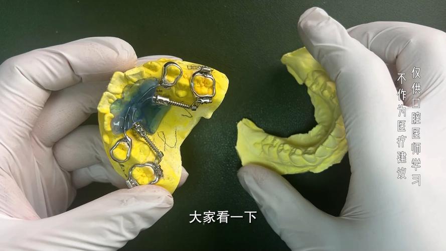 传统正畸磨牙远移的方法有哪些？如何操作？-图2