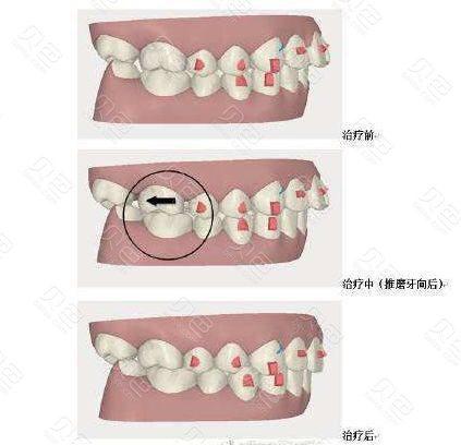 传统正畸磨牙远移的方法有哪些？如何操作？-图3