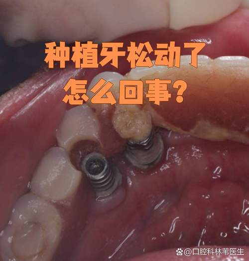 种牙后会不会松动？影响使用和寿命吗？-图2
