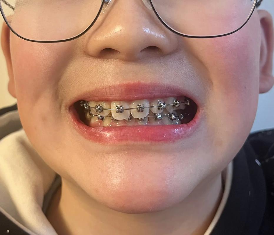 正畸中前牙缝隙关不上，是什么原因导致的？-图3