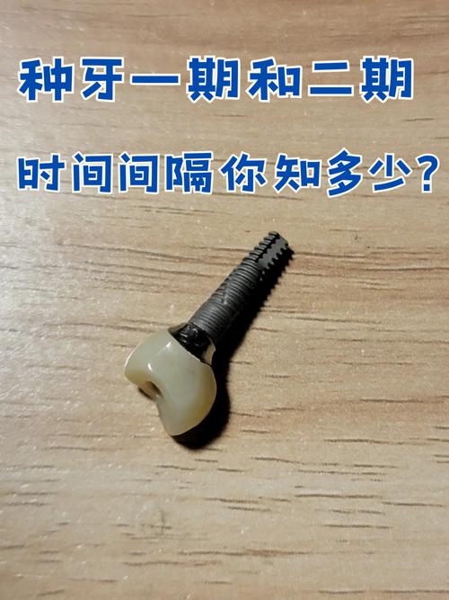 种牙埋件能用多久？使用寿命受哪些因素影响？-图1