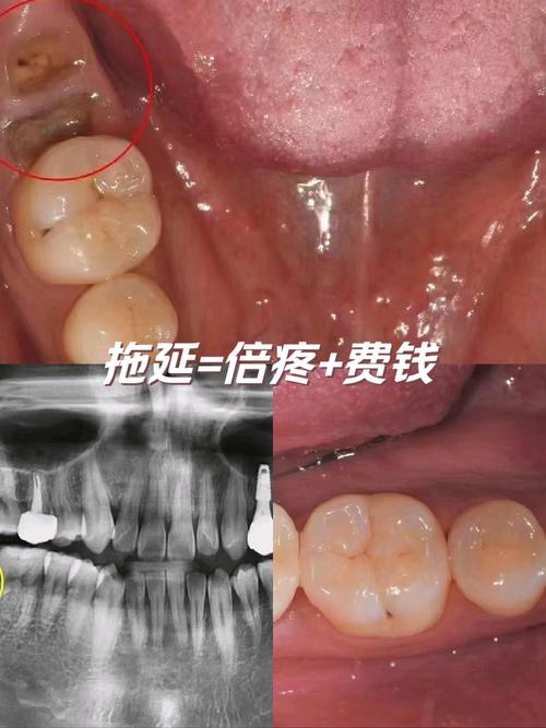 牙脱了可种回去吗-图3 牙脱了可种回去吗-图3