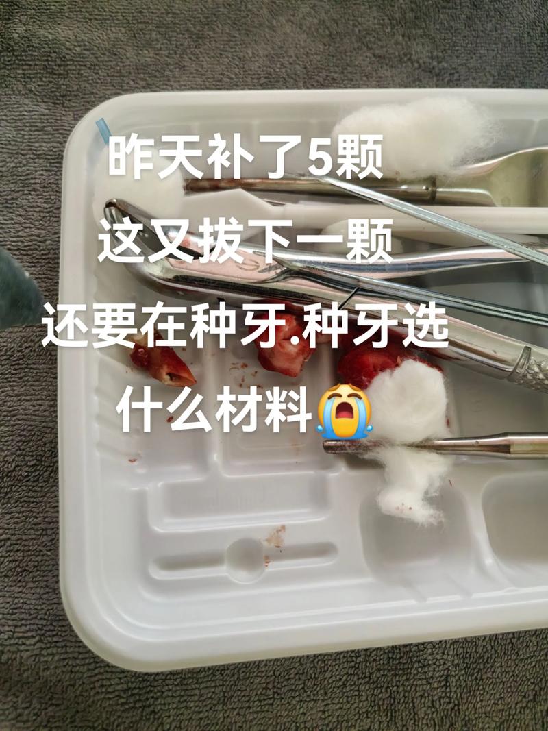 种牙常用哪些材质?安全耐用怎么选?-图1 种牙常用哪些材质?安全耐用怎么选?-图1