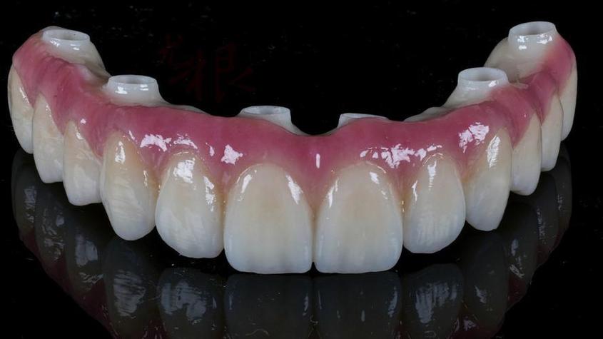 种牙常用哪些材质?安全耐用怎么选?-图3 种牙常用哪些材质?安全耐用怎么选?-图3