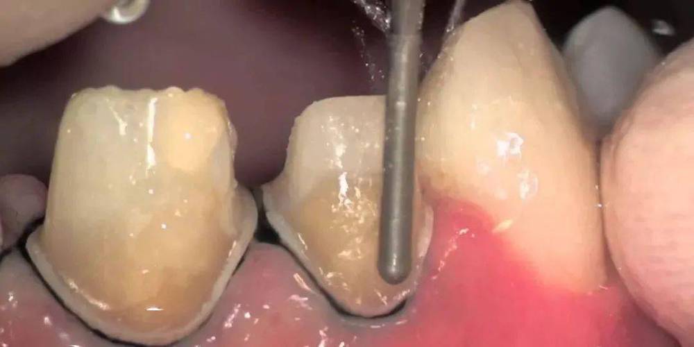 牙冠肩台预备方法的关键步骤与注意事项是什么？-图1