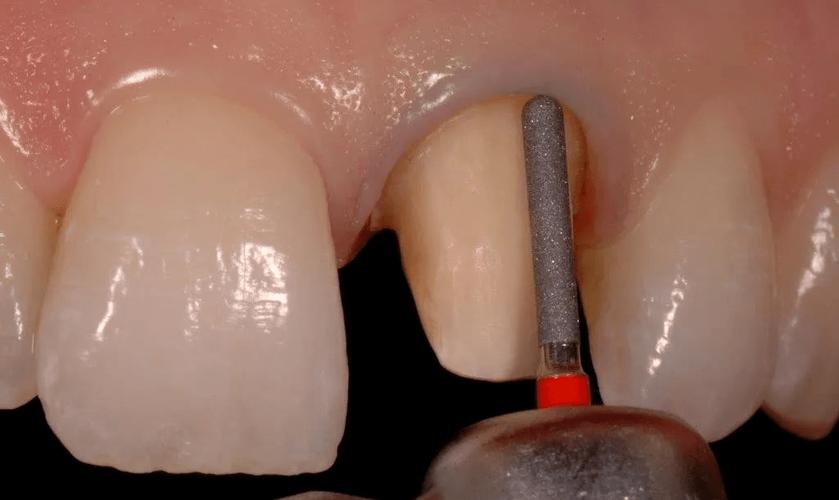 牙冠肩台预备方法的关键步骤与注意事项是什么？-图2