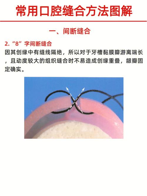 口内缝合打结如何规范操作？方法与技巧详解-图2