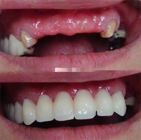 种牙之前能喝酒嘛-图3