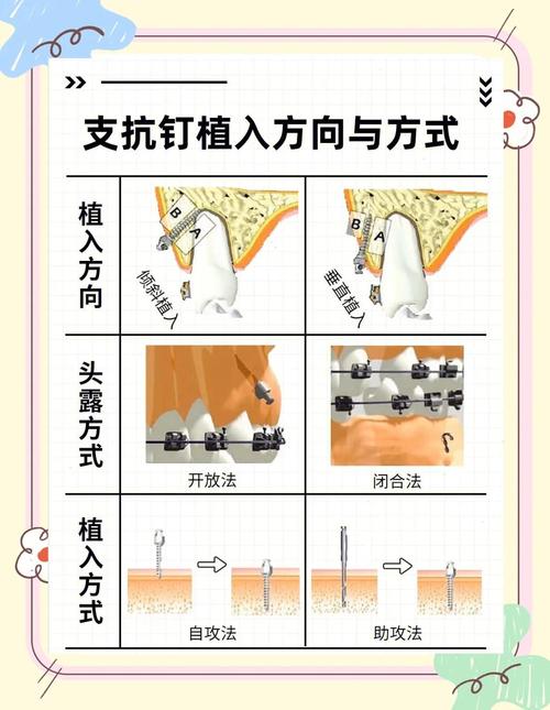 下颌种植支抗方法的适用情况与效果怎样？-图1