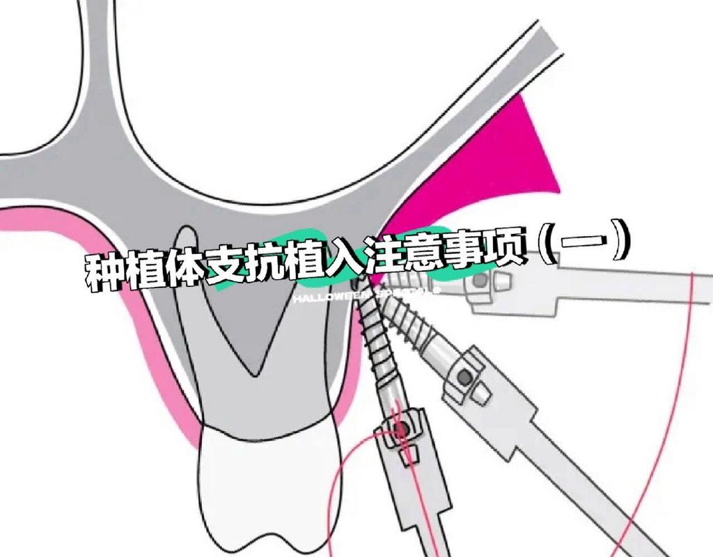 下颌种植支抗方法的适用情况与效果怎样？-图3