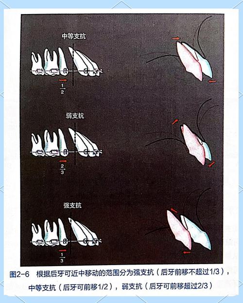 正畸支抗植入方法的选择与应用如何规范？-图3