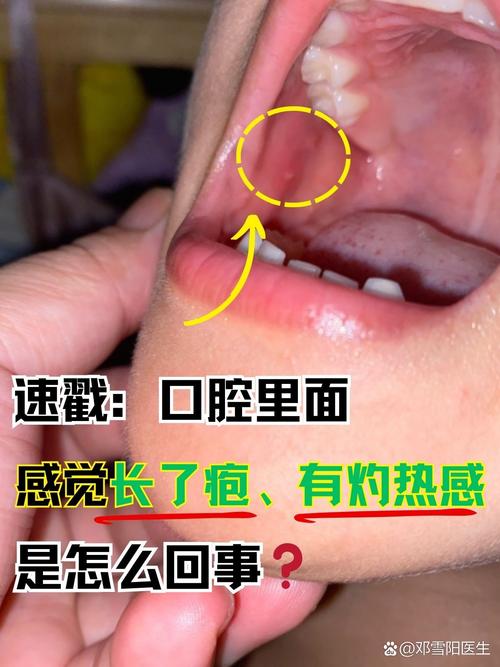 嘴里上火最快有效缓解方法有哪些？-图2