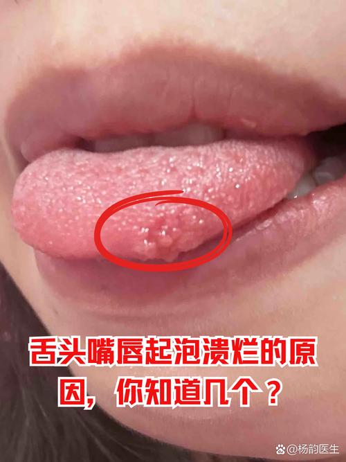 嘴里上火最快有效缓解方法有哪些？-图1
