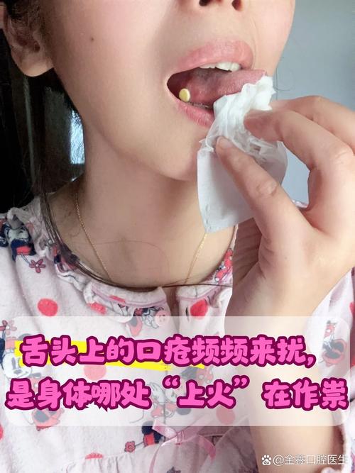嘴里上火最快有效缓解方法有哪些？-图3