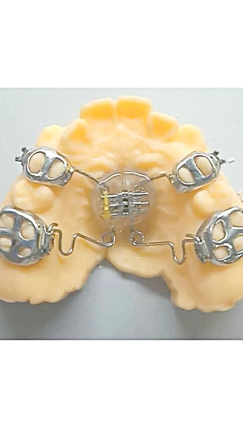 支抗磨牙后移的有效方法有哪些？-图1