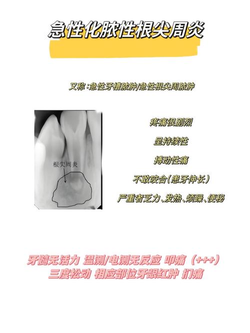 牙髓炎的诊断方法有哪些？这些关键方法你了解吗？-图3