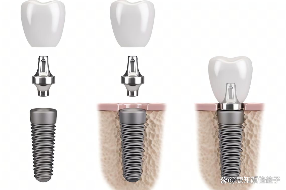 珠海拜博口腔种牙价格怎么样？效果可靠吗？-图3