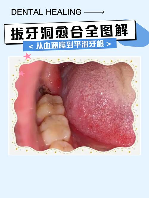 拔牙后牙齿怎么修复？常用方法有哪些？-图1