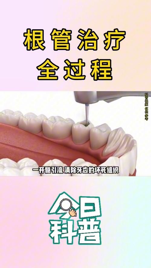 上牙根管治疗的具体步骤和方法是什么？-图2