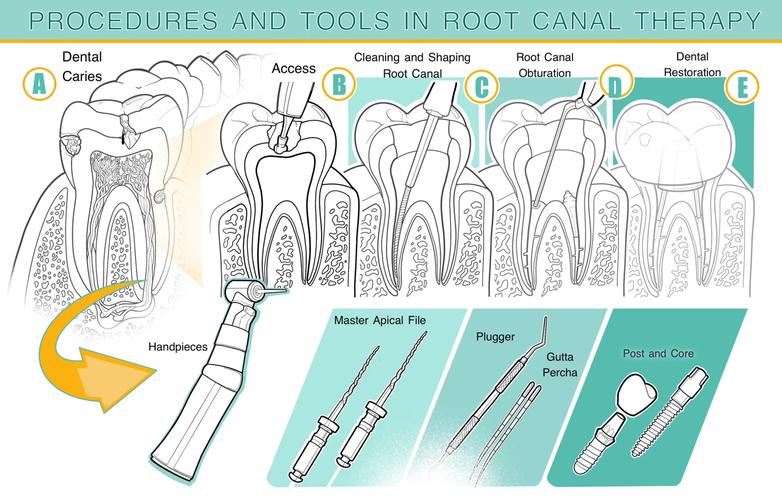 上牙根管治疗的具体步骤和方法是什么？-图3