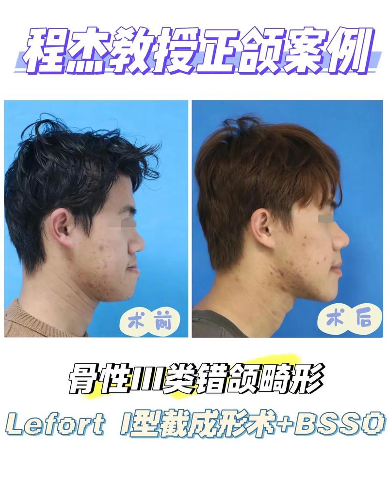 掩饰性正畸治疗后下巴变短是怎么回事？-图3