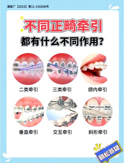 正畸一类牵引方法如何规范操作?适用哪些错颌情况?-图2 正畸一类牵引方法如何规范操作?适用哪些错颌情况?-图2