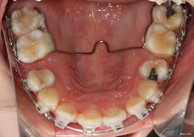 正畸TPA的英文是什么？它的全称又是什么？-图1