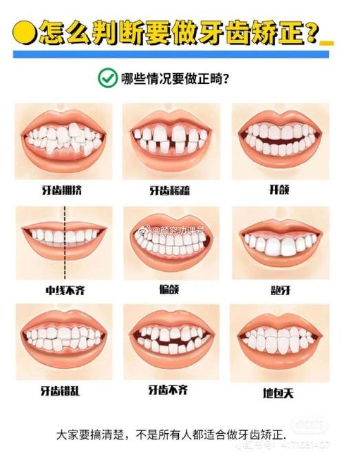 纠正牙齿的简单方法有哪些？哪种更安全有效？-图3