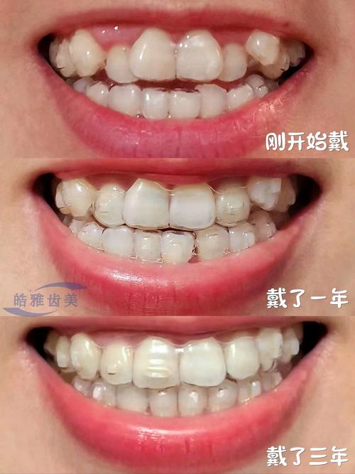 成都隐形正畸温馨春天，隐形正畸效果怎么样？-图2