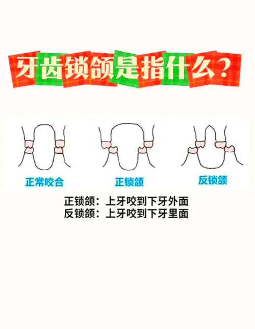 正畸锁颌治疗的最佳方法是什么？-图1