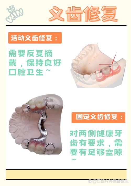 活动义齿摘戴的正确方法有哪些步骤和技巧?-图2 活动义齿摘戴的正确方法有哪些步骤和技巧?-图2