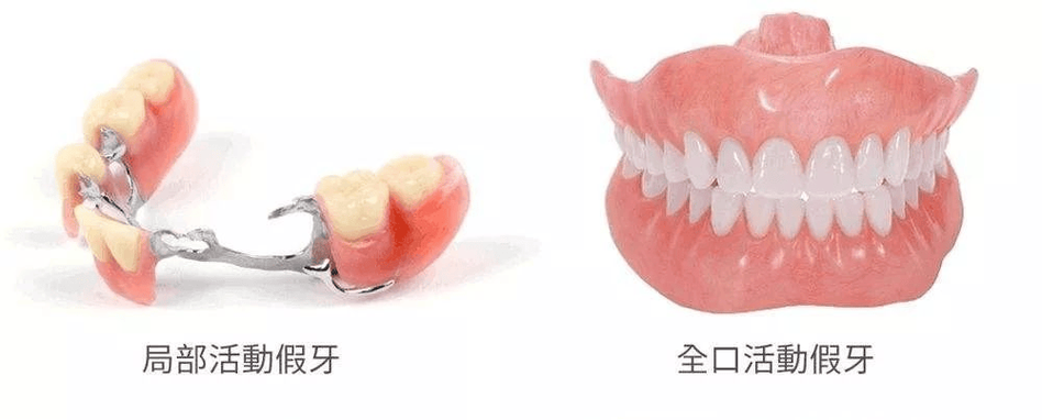 活动义齿摘戴的正确方法有哪些步骤和技巧?-图1 活动义齿摘戴的正确方法有哪些步骤和技巧?-图1