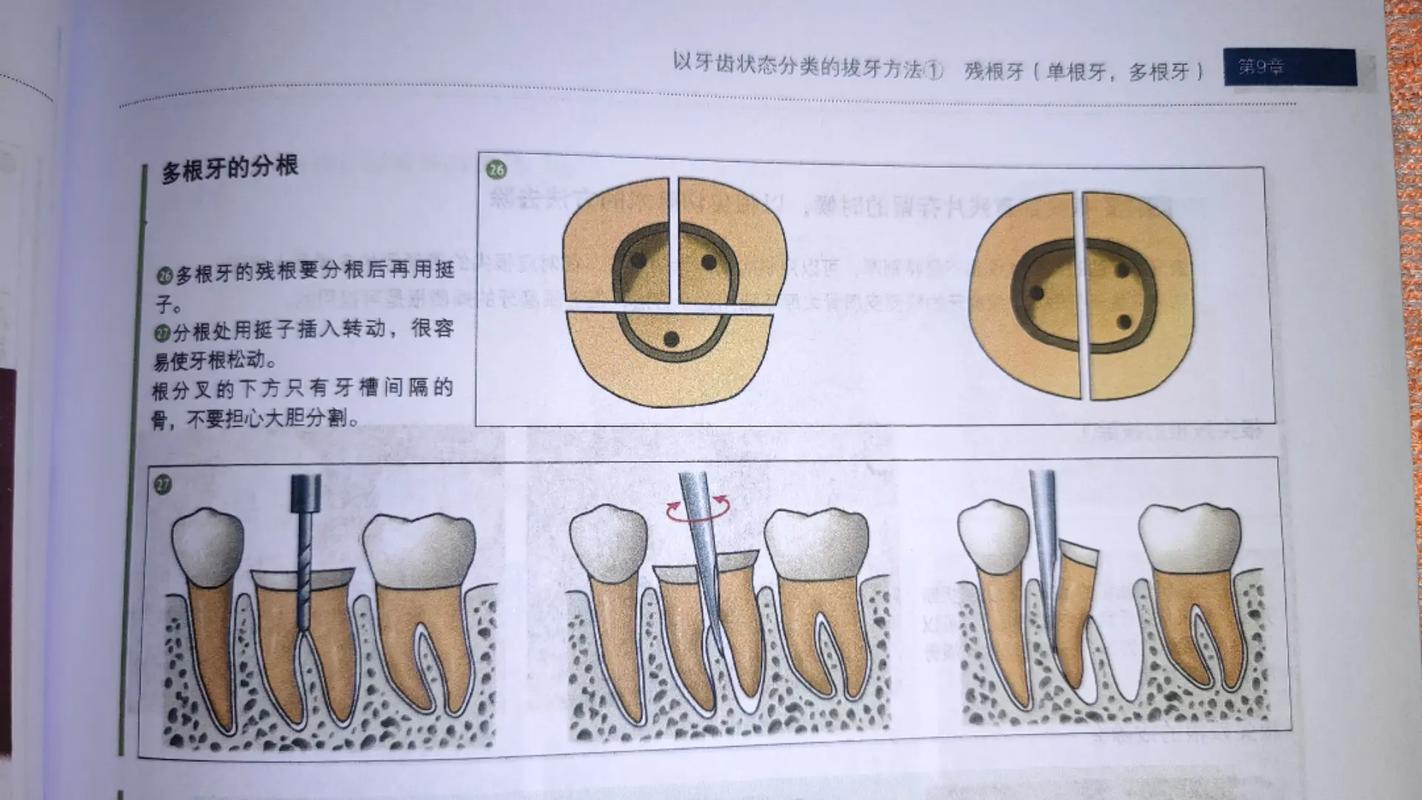 口腔拔牙基本方法有哪些关键步骤？-图3