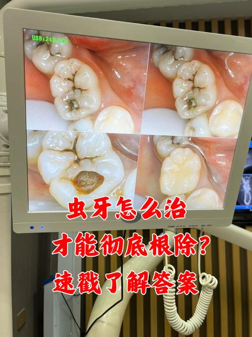 儿童虫牙治疗方法有哪些？如何选对合适方案？-图3