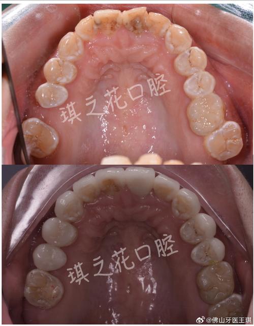 口腔正畸病例图片如何有效展示矫治效果？-图2