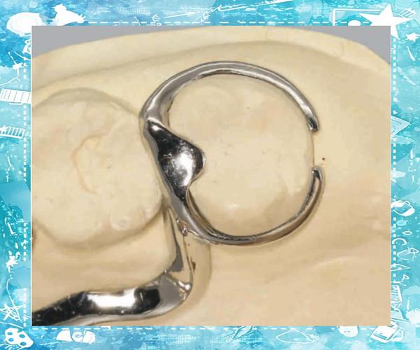 口腔正畸中卡环图片包含哪些常见类型及作用？-图1