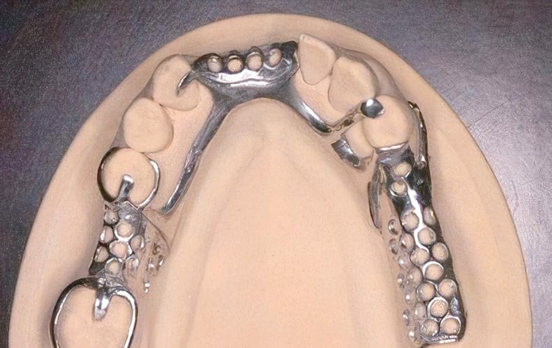 口腔正畸中卡环图片包含哪些常见类型及作用？-图2