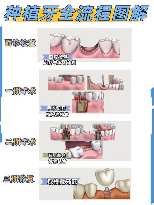 牙齿折断一半，种牙修复是必要选择吗？-图2
