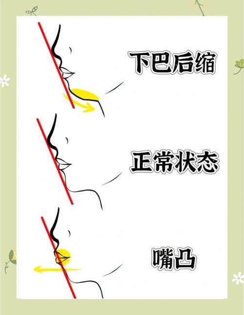 下颌后缩矫正方法有哪些？哪种更有效？-图3