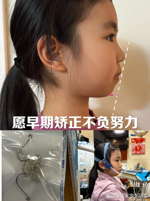 儿童偏颌矫正方法有哪些？如何科学选择？-图1