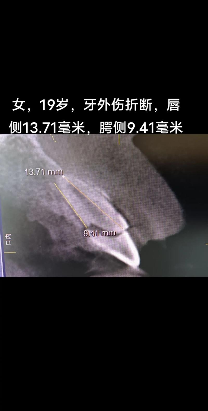 牙断了,种牙还是修补?哪种方式更适合你?-图3 牙断了,种牙还是修补?哪种方式更适合你?-图3
